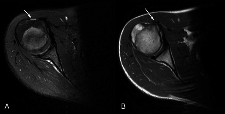 Two axial shoulder MR images, A and B, with arrows at the bicipital groove on the anterior humeral head
