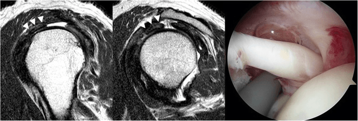 Two shoulder MR images with arrowheads along an enlarged long head biceps tendon, beside an arthroscopic view of a thickened tendon