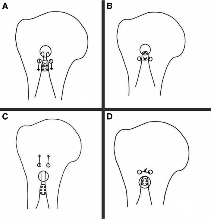 Four line drawings of the proximal humerus comparing two intraosseous biceps tenodesis configurations: in A and B the sutures exit beside the tendon tunnel and are tied there, in C and D they exit through holes above it and are tied above
