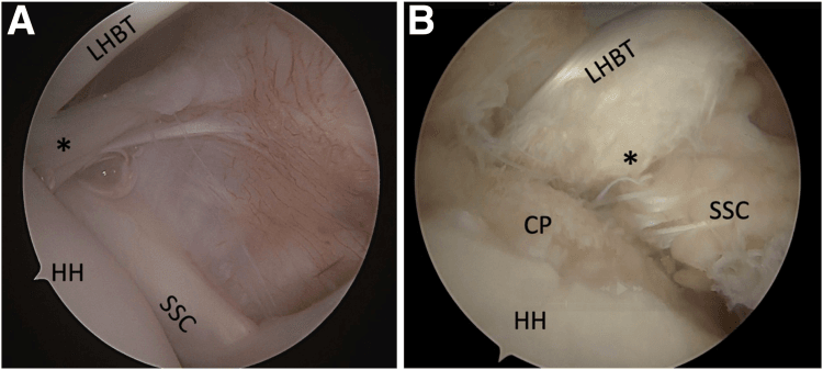 Two arthroscopic views labelled LHBT, HH and SSC: in A an intact medial biceps sling (asterisk), in B a disrupted sling (asterisk) with the chondral print (CP) exposed and a torn upper subscapularis