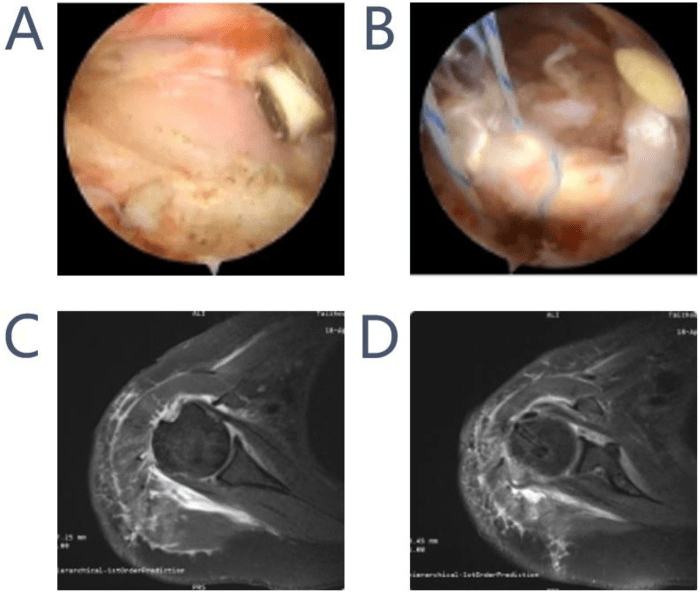 Arthroscopic views (A, B) and postoperative axial shoulder MR images (C, D) from a comparison of tenotomy and tenodesis