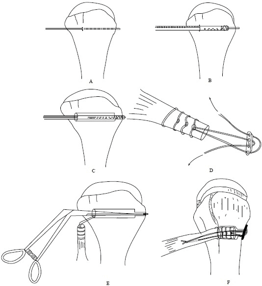 Six line drawings, A to F, of suprapectoral tension-slide biceps tenodesis: drilling across the proximal humerus, loading the whipstitched tendon on a cortical button, passing it into the tunnel with forceps and tensioning it with the button on the far cortex