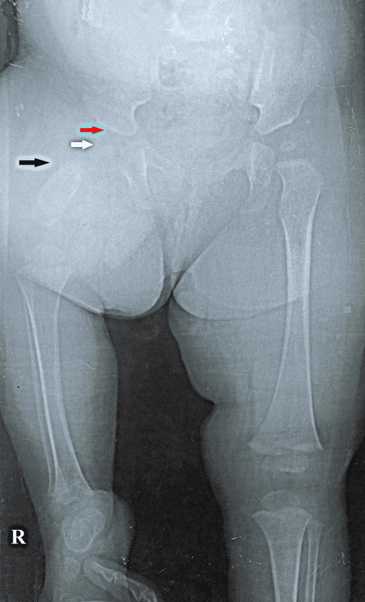 Radiograph showing Aitken A proximal femoral focal deficiency