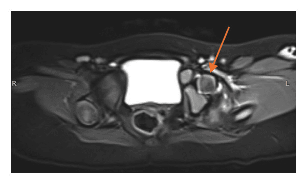 Axial MRI showing Aitken B proximal femoral focal deficiency