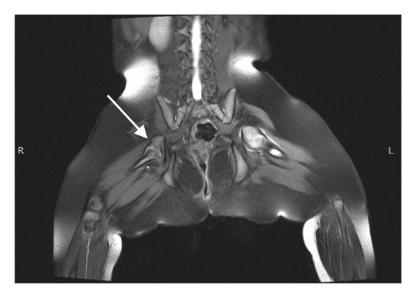 Coronal MRI showing Aitken C proximal femoral focal deficiency