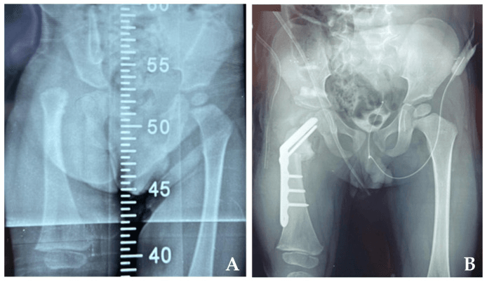 Preoperative and postoperative radiographs after blade plate reconstruction of congenital femoral deficiency