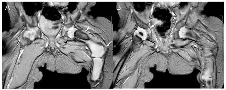 Coronal MRI showing cartilaginous proximal femur in proximal femoral focal deficiency