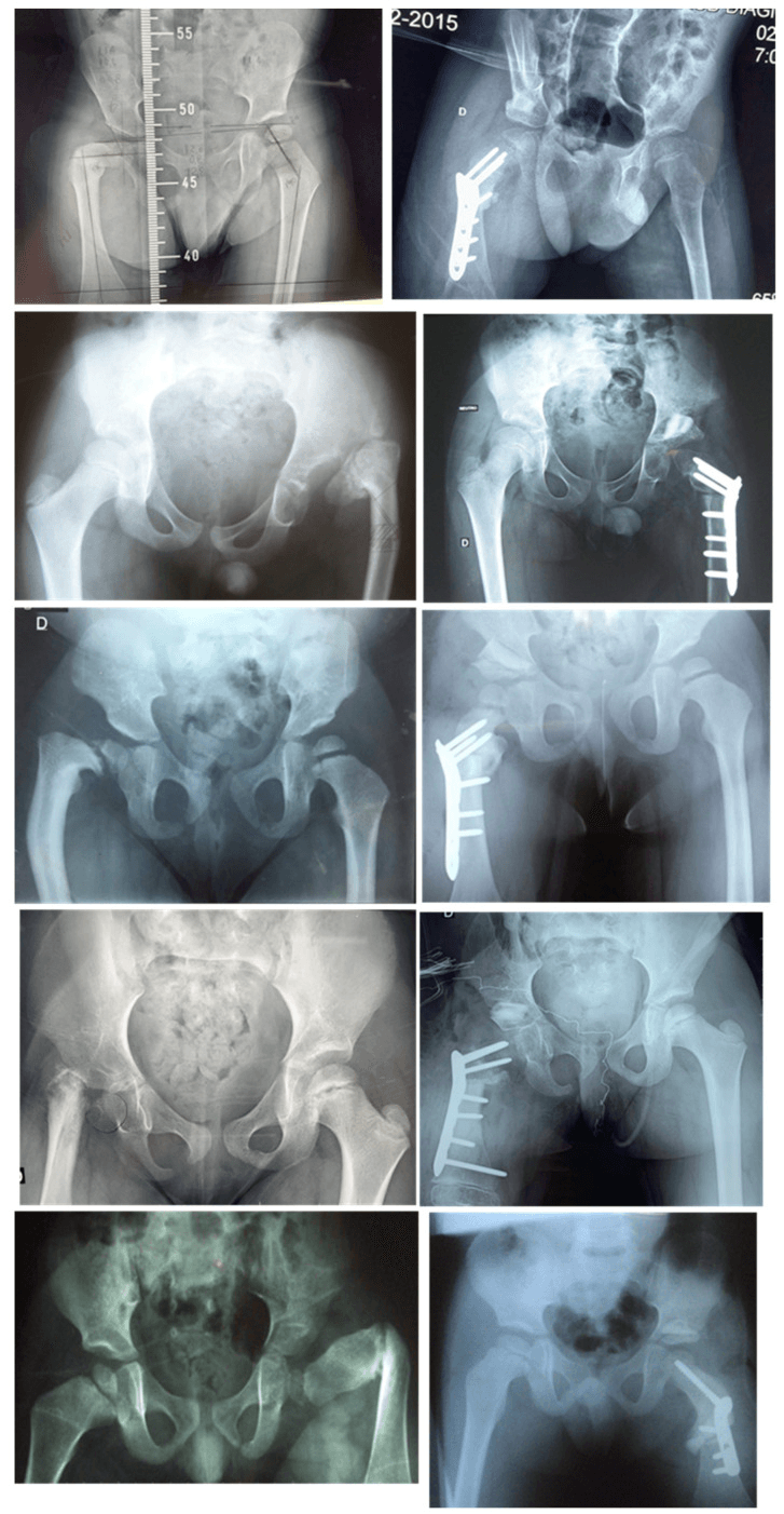 Paired preoperative and postoperative radiographs of proximal femoral locking plate reconstruction for delayed femoral neck ossification