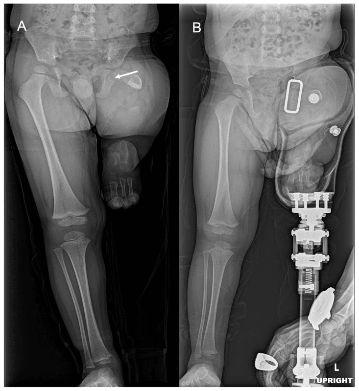 Standing radiographs before and with prosthetic fitting for severe femoral deficiency