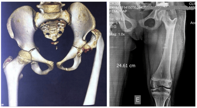 Five year follow-up imaging after SUPERhip reconstruction