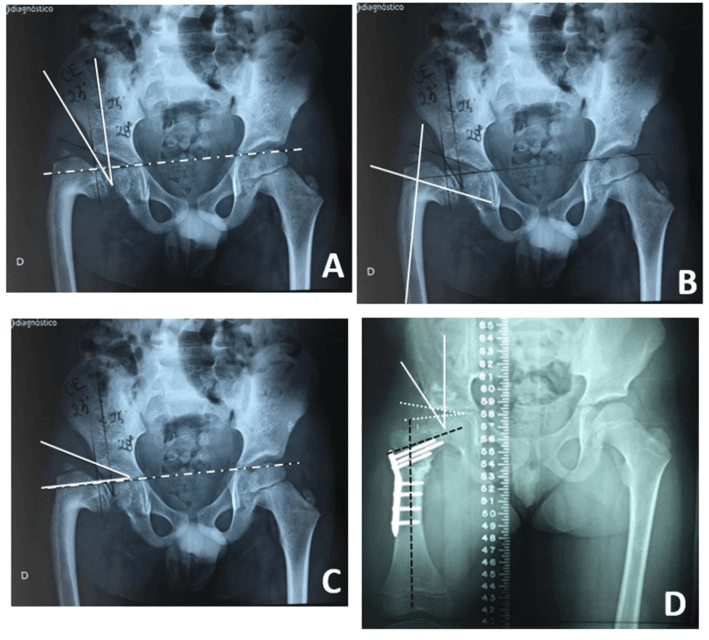 Hip radiographs demonstrating centre edge neck shaft and acetabular index planning