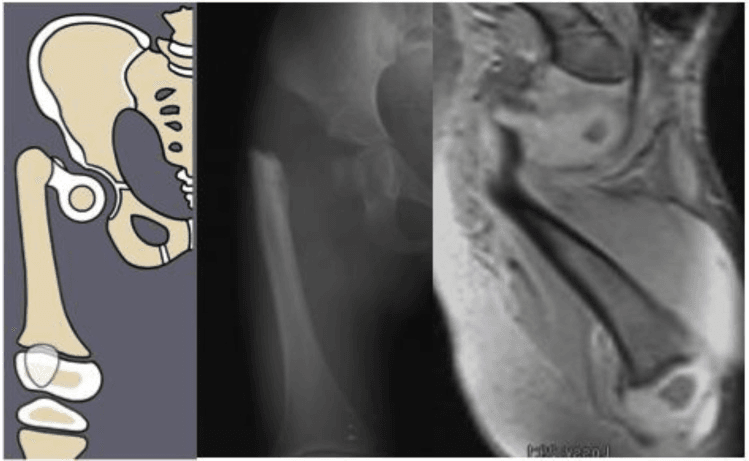 Paley Type 1b2 congenital femoral deficiency on schematic radiograph and MRI