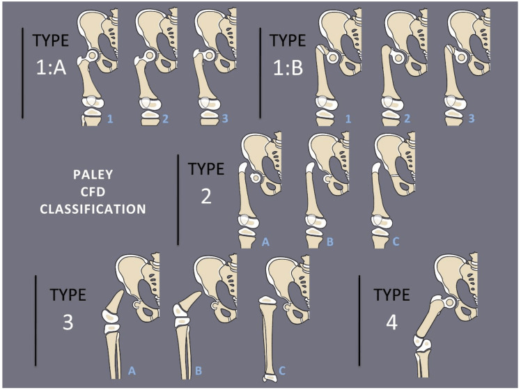 Paley classification illustration for congenital femoral deficiency Types 1A through 4