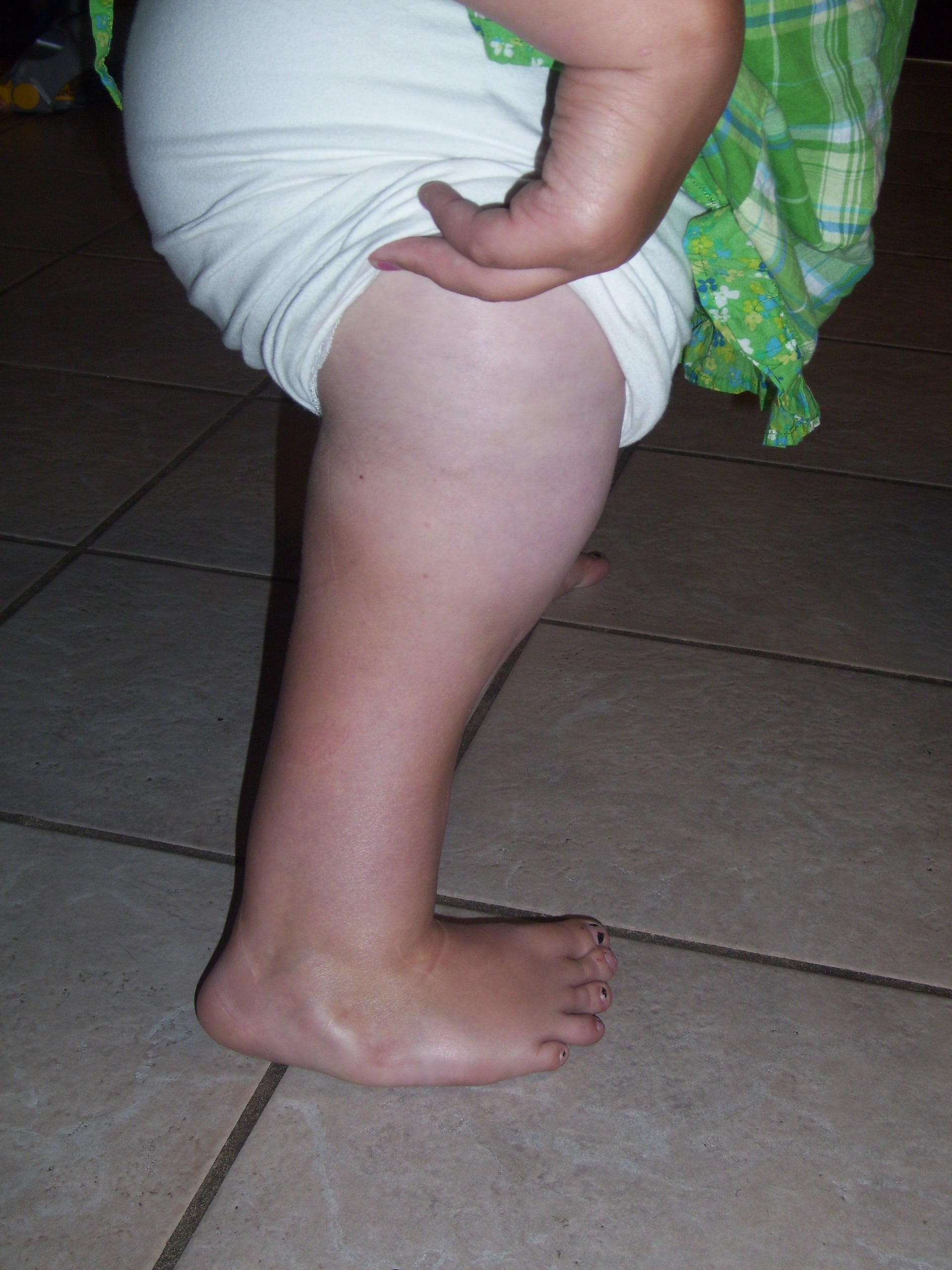 Lateral clinical photograph of the affected lower limb of a young child with congenital femoral deficiency, showing a short bulky thigh and the foot resting plantigrade on the floor close to the trunk.