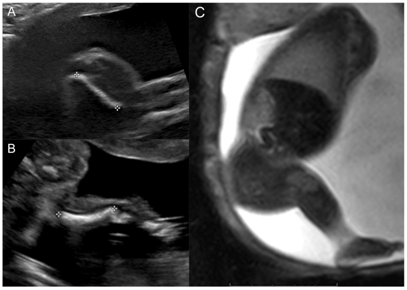 Prenatal ultrasound and fetal MRI showing short femur with absent fibula