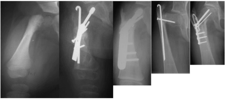 Serial radiographs showing delayed ossification and revision after SUPERhip reconstruction