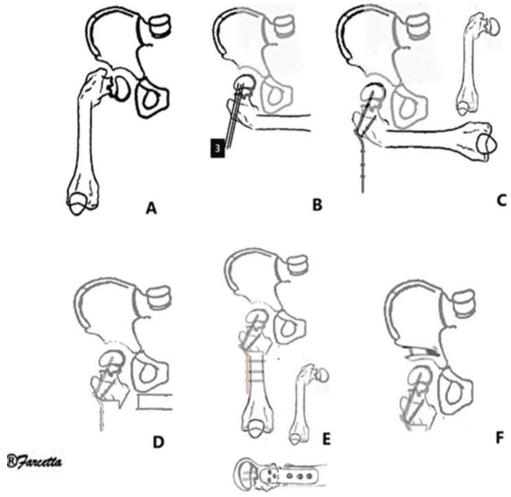 Stepwise technical diagrams of SUPERhip femoral and pelvic osteotomies