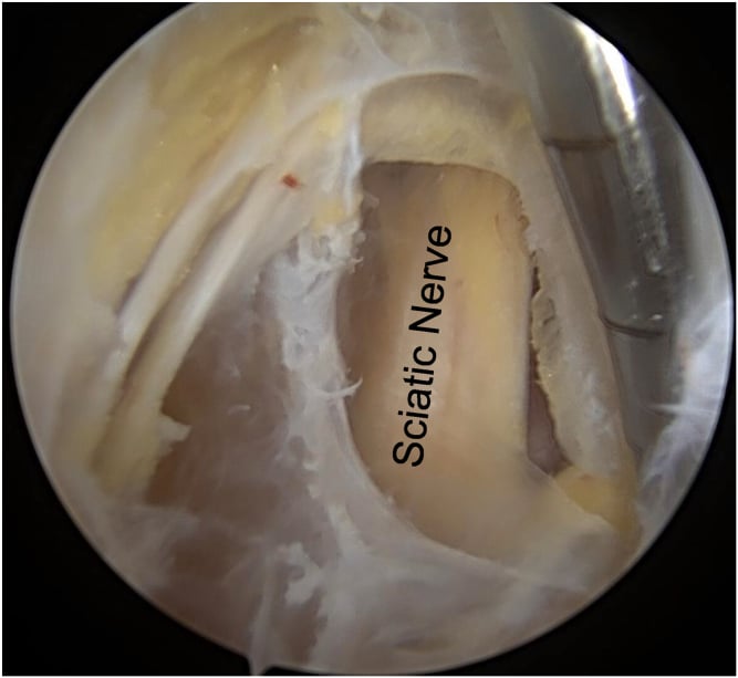 Endoscopic view of the sciatic nerve after neurolysis beside the proximal hamstring origin