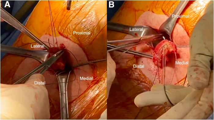 Running-locking suture passage through the proximal hamstring tendon stump