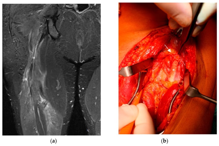 MRI and operative neurolysis of sciatic nerve entrapment after proximal hamstring avulsion