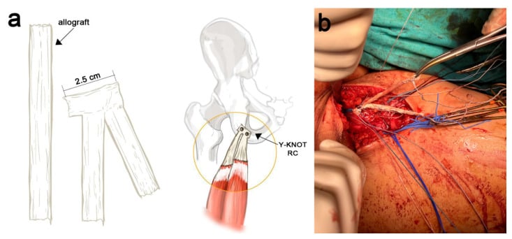 Semitendinosus allograft preparation for chronic proximal hamstring reconstruction
