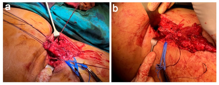 Operative placement and tendon suturing of an allograft for chronic proximal hamstring avulsion