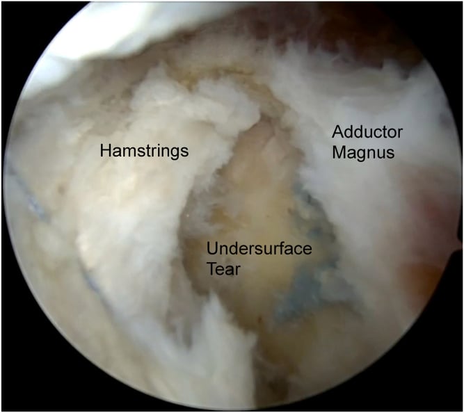 Endoscopic view of a proximal hamstring undersurface tear beside adductor magnus