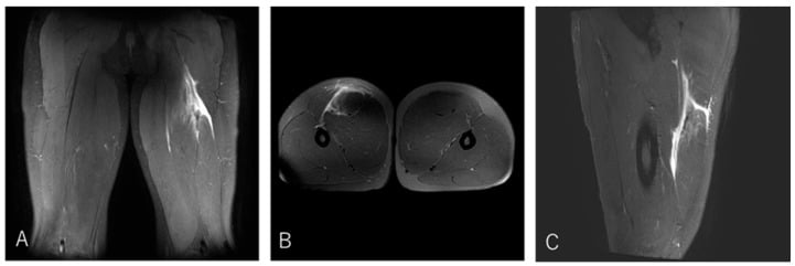 Coronal axial and sagittal MRI of complete conjoint tendon rupture with haematoma and retraction