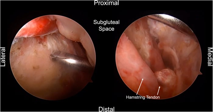 Endoscopic subgluteal bursectomy exposing the proximal hamstring region