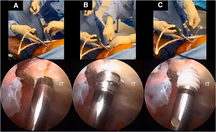 Endoscopic preparation and placement of a suture anchor in the ischial tuberosity