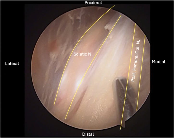 Endoscopic identification of the sciatic and posterior femoral cutaneous nerves during hamstring repair
