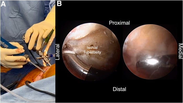 Endoscopic debridement and decortication of the ischial hamstring footprint