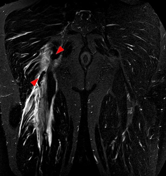 Coronal fluid-sensitive MRI of the pelvis showing bright oedema and fluid at the right ischial tuberosity hamstring origin, indicating a proximal hamstring avulsion, with a normal dark left origin.