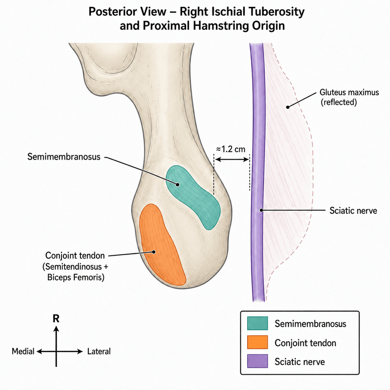 Posterior view of the right ischial tuberosity showing the semimembranosus and conjoint tendon origin footprints and the sciatic nerve running 1.2cm lateral