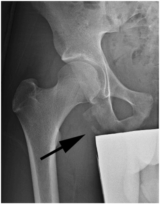 AP pelvis X-ray showing ischial tuberosity avulsion fracture