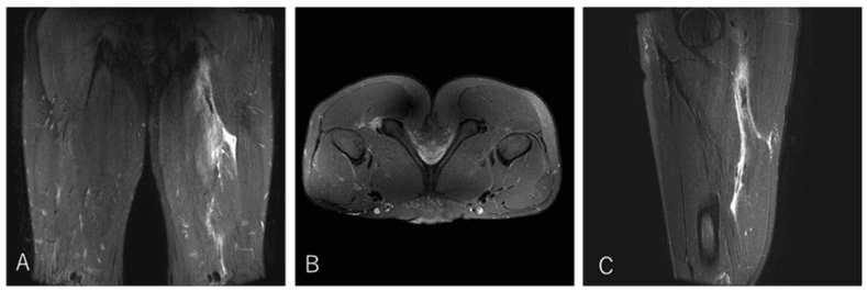 Coronal, axial and sagittal MRI of conjoint tendon detachment from the ischial origin