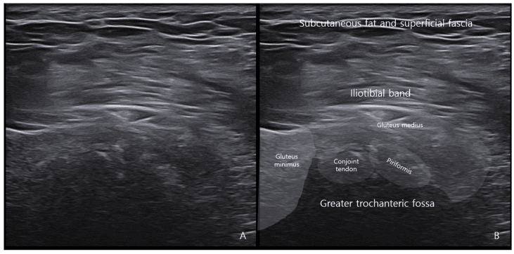 Paired ultrasound images of the deep gluteal region, unlabelled and with anatomical labels