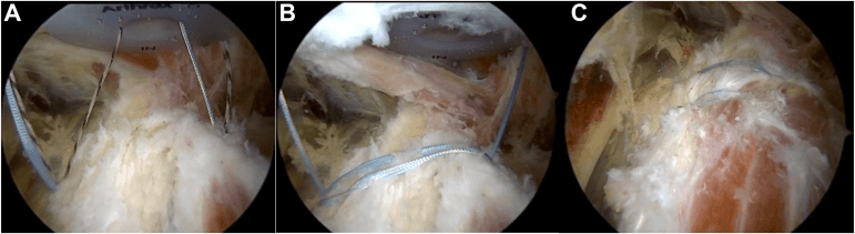 Three endoscopic views of suture tapes tightened over the proximal hamstring tendon in an anchor-based repair