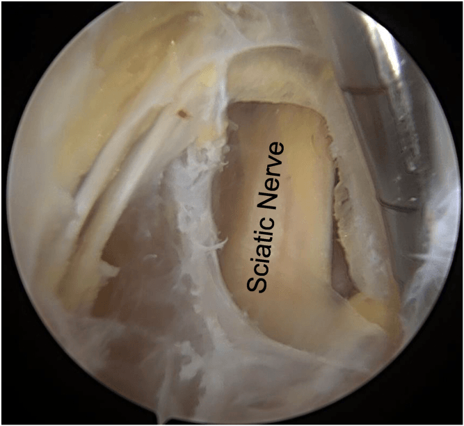 Endoscopic view with the sciatic nerve labelled after neurolysis