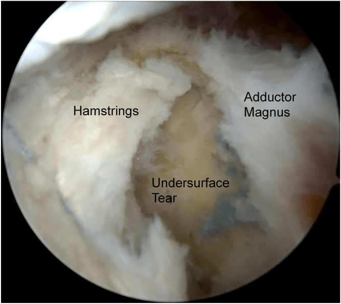 Endoscopic view of undersurface proximal hamstring tear beside adductor magnus