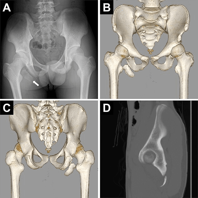 AP pelvis radiograph, three-dimensional CT reconstructions and a CT slice of a displaced ischial tuberosity avulsion fragment