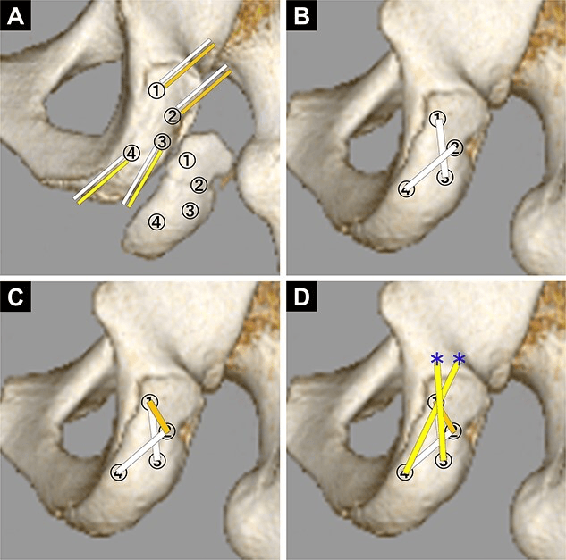 CT based schematic of suture bridge fixation for ischial avulsion fragment