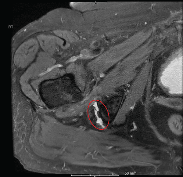 MRI slice with a red ellipse around bright fluid signal at the proximal hamstring insertion