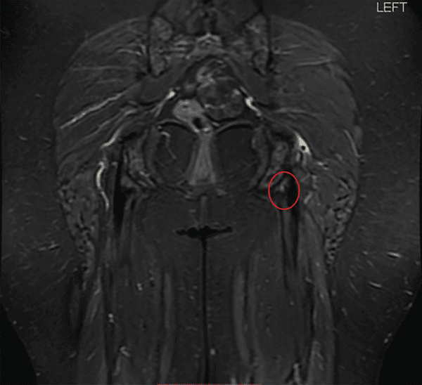 Coronal MRI marked LEFT with a red circle around subtle signal change at the left proximal hamstring origin