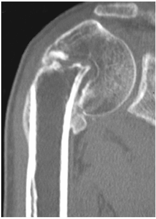 CT coronal view showing valgus impacted proximal humerus fracture with plate fixation
