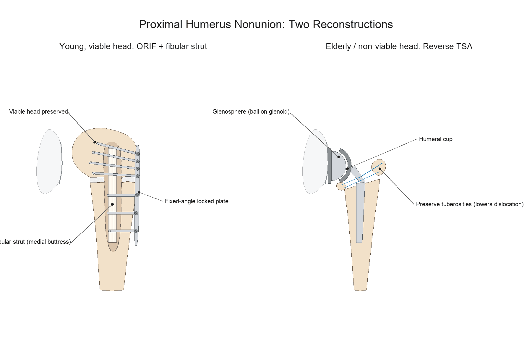 Diagram of the two reconstructions for proximal humerus nonunion: ORIF with a locked plate and intramedullary fibular strut for a viable head, versus reverse total shoulder arthroplasty for a non-viable head