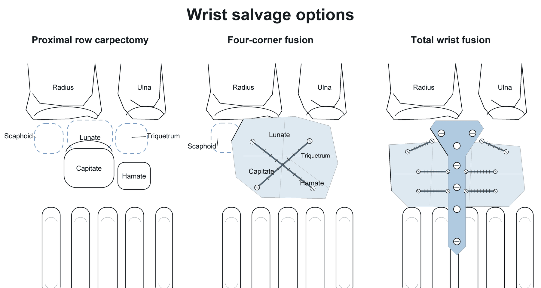 Schematic comparing proximal row carpectomy, four-corner fusion and total wrist fusion of the carpus