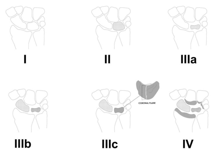 Diagram of Lichtman stages I through IV of Kienbock disease