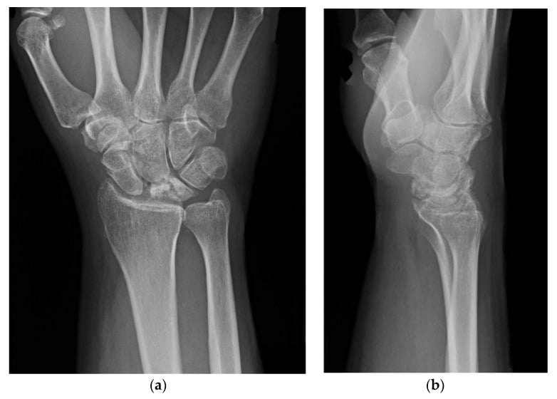 AP and lateral wrist radiographs showing stage-IIIB Kienbock disease with lunate collapse and scaphoid rotation