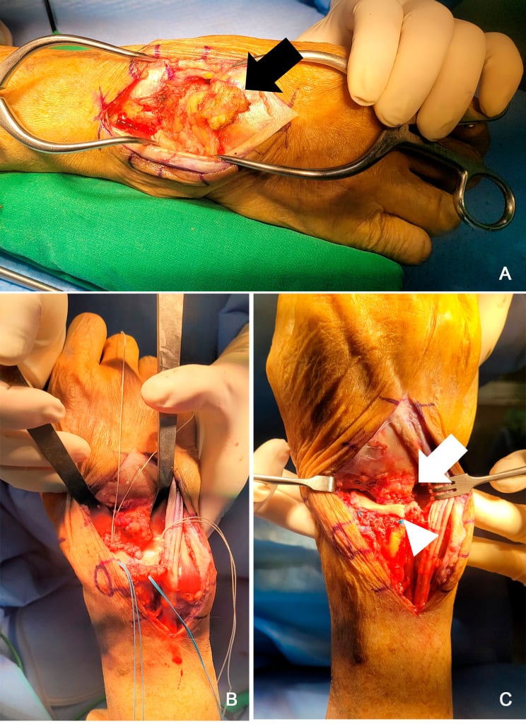 Three operative panels showing dorsal capsular and dermal-allograft interposition after proximal row carpectomy